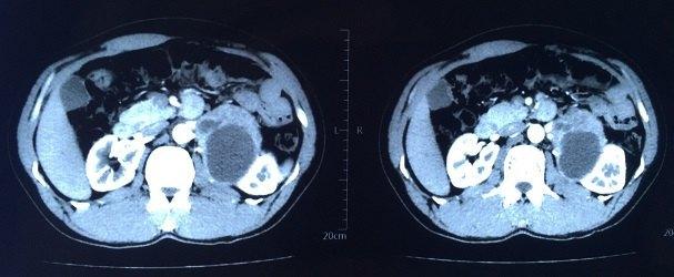 科普下肾上腺髓质嗜铬细胞瘤及生化诊断是什么