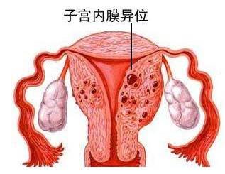 研究人员使用纳米技术开发子宫内膜异位症的新疗法