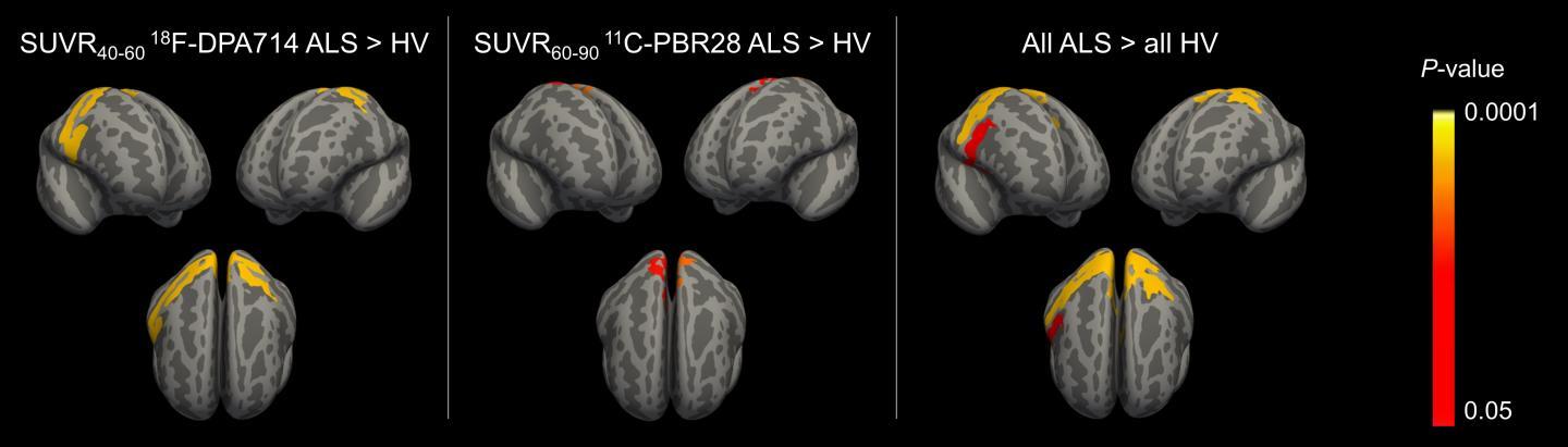 PET研究可以检测ALS中的神经炎症