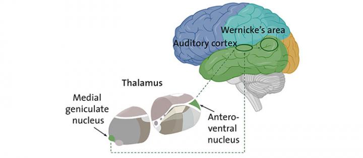 精神分裂症的最典型症状与丘脑下部结构和大脑皮层之间的过度联系有关