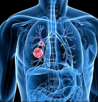 研究人员确定小细胞肺癌中的移动目标