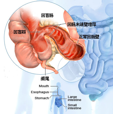 克罗恩氏病是一种以胃肠道的慢性炎症和纤维化为特征的疾病