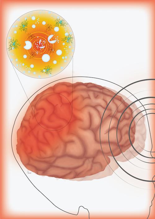 研究人员评估头部外伤期间气泡引起的脑细胞损伤