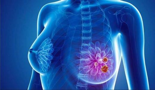 研究人员认为药物引起的间质性肺病是乳腺癌患者的病因