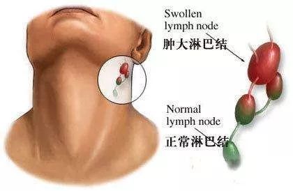 淋巴结可以预测食管癌患者的生存率