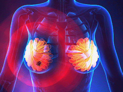 最新数据证实了利巴昔单抗在乳腺癌中具有生存优势以及副作用