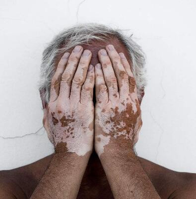 曾经被认为是罕见的皮肤病皮肤瘙痒比想象的更常见