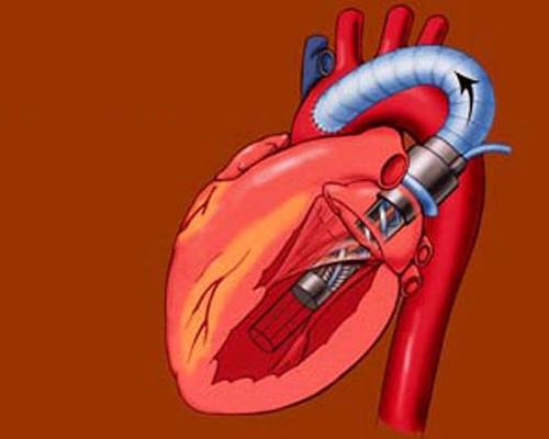 心脏支架手术后某些患者的心脏泵与并发症相关