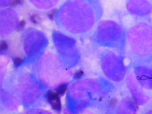 黑色素瘤中某些免疫蛋白酶体亚基的过度表达与抗癌免疫活性有关