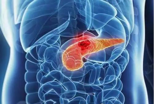 MD Anderson研究证实蛋白质是最常见类型胰腺癌的潜在原因