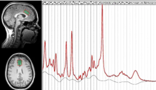 神经科学家对酒精中毒者大脑中的实时变化进行成像
