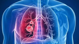 科学家发现与致命性肺病有关的三个基因
