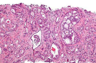 人乳头瘤病毒在前列腺癌中的潜在因果作用
