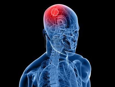 低剂量放射疗法可改善治疗性纳米粒子向脑肿瘤的输送