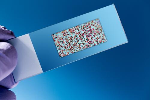 使用纳米技术增强的生物芯片检测到微小的疾病水平