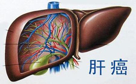 基因与最常见的肝癌有关