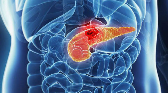 新的研究针对阿基里斯的胰腺癌取得了良好的效果