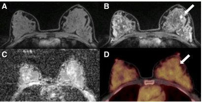 PET/MRI可识别出显着的乳腺癌影像生物标志物
