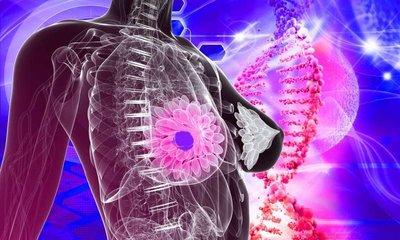 研究发现乳腺癌患者面临高死亡率