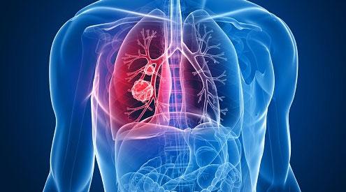 科学家确定了与肺癌和黑色素瘤进展有关的蛋白质