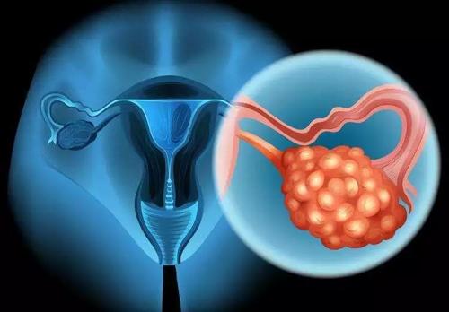 国际团队开发了一种新的测试方法可以更好地诊断不同类型的卵巢癌