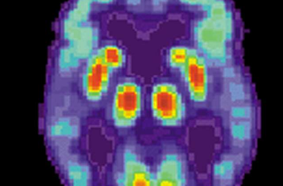 患有阿尔茨海默氏症危险因素的成年人的大脑网络仍有细微变化