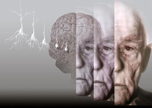 阿尔茨海默氏病如何在整个大脑中传播