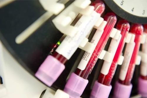 将来可以使用血液样本评估FTLD的严重程度和预后