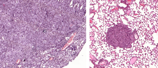 鳞状细胞癌为什么是一种非常不寻常的癌症