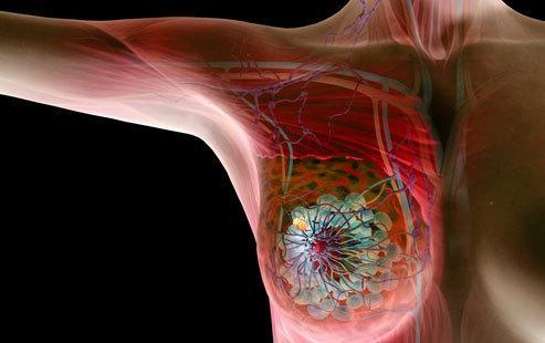 带有政府保险的乳腺癌患者死亡风险更高