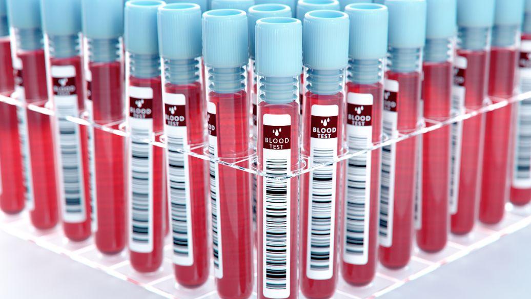 研究表明验血可以指导膀胱癌的精准治疗