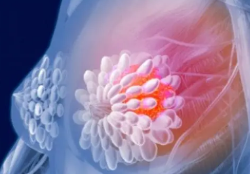 研究发现乳腺癌对肿瘤硬度的反应可以预测骨转移