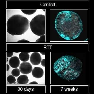 研究人员揭开Rett综合征背后的遗传机制