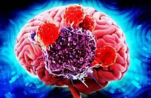 在脑癌患者中发现的结构可以帮助对抗肿瘤