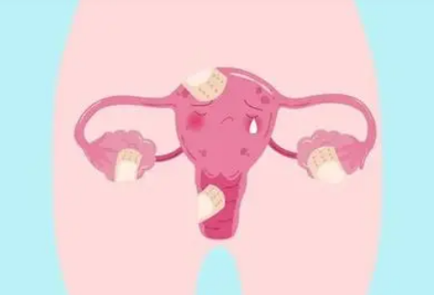 子宫内膜异位症如何影响女性的工作生活
