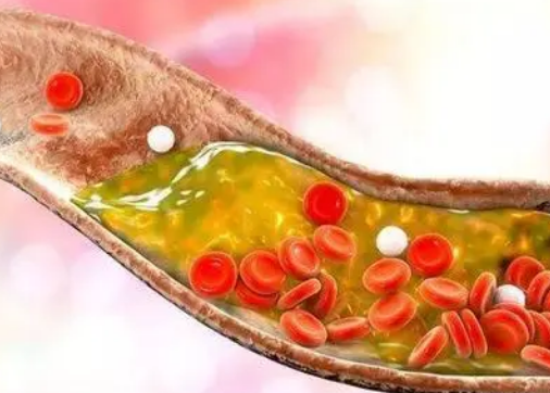 基因分析技术发现甲状腺功能与血脂之间的缺失联系