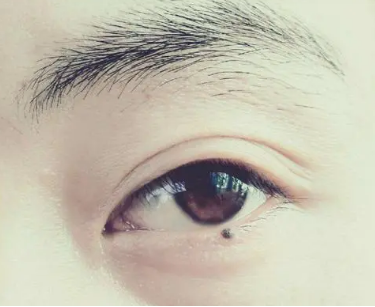 眼部黑色素瘤：临床前测试显示了治疗途径