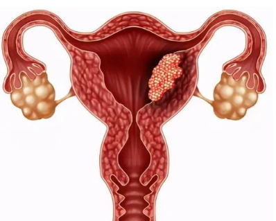 TVUS筛查漏诊的黑人女性子宫内膜癌病例是女性的四倍多