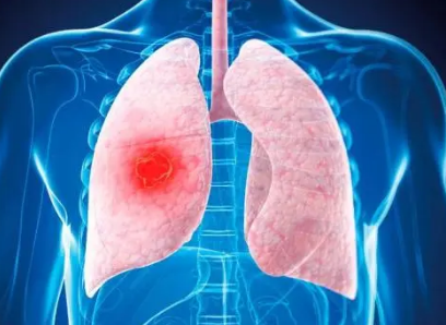研究确定MET扩增是某些非小细胞肺癌的驱动因素