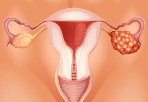 器官芯片发现血液和卵巢癌之间的关键联系