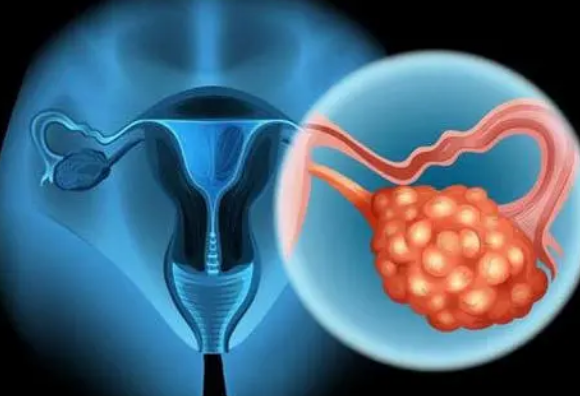 探索导致卵巢癌扩散的微观缺陷