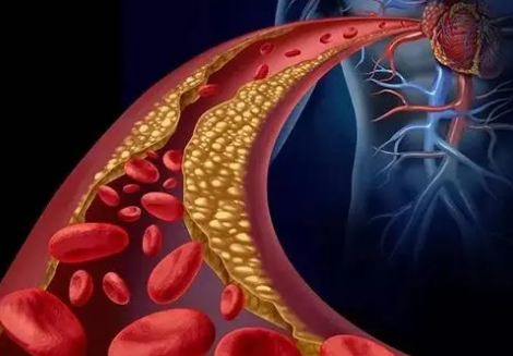 HeartCare研究确定患者患心血管疾病的遗传风险