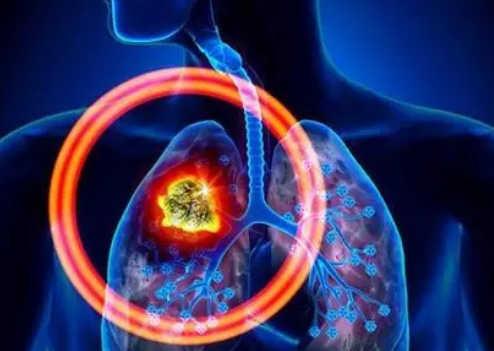 全球手术研究表明术前隔离的患者发生术后肺部并发症的可能性高20%