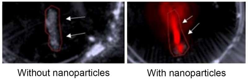 一种新的成像技术使用纳米粒子来帮助揭示动脉中的脆弱斑块