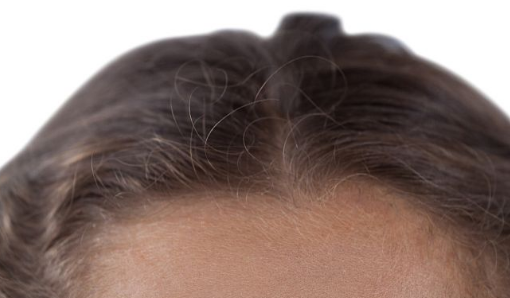 研究人员用可溶解的微针贴片治疗秃头的根本原因