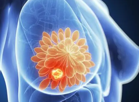 研究人员确定三阴性乳腺癌耐药机制
