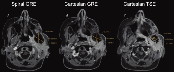 3D螺旋序列克服了头颈部MRI的传统挑战