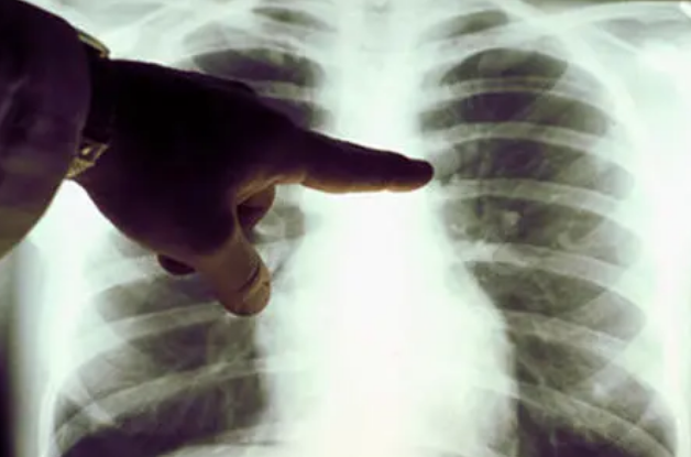 新研究提供了在没有危险活检的情况下对肺部瘢痕形成疾病的见解