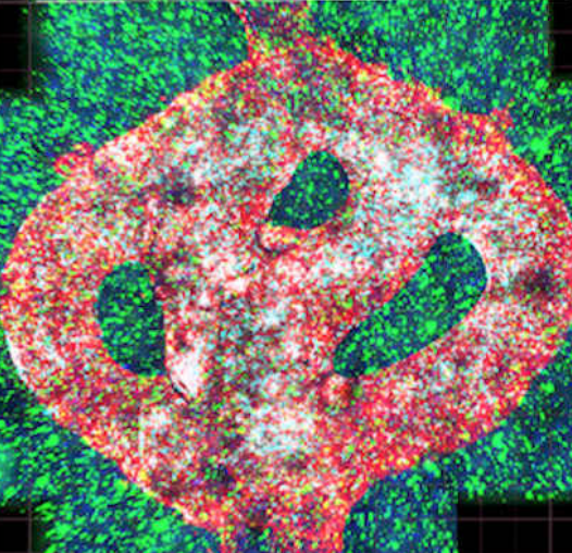 研究人员用来自患者的细胞创建3D肿瘤模型