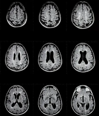 NIH科学家构建了多发性硬化病变的细胞蓝图